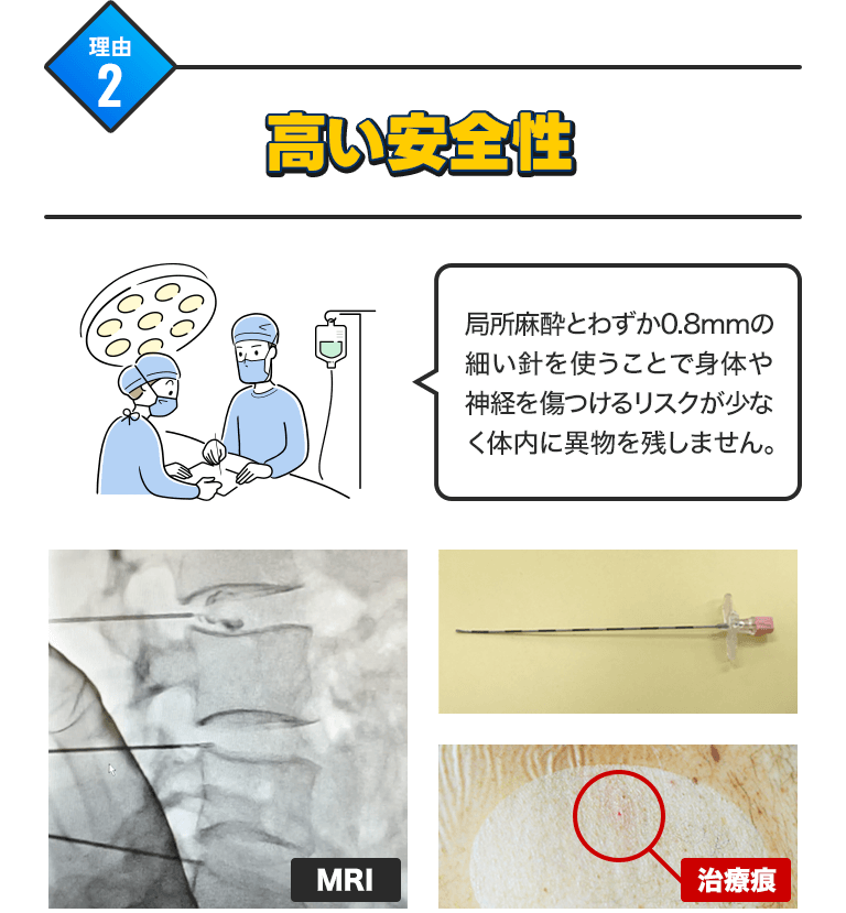 理由2)高い安全性:局所麻酔とわずか0.8mmの細い針を使うことで身体や神経を傷つけるリスクが少なく、体内に異物を残しません。