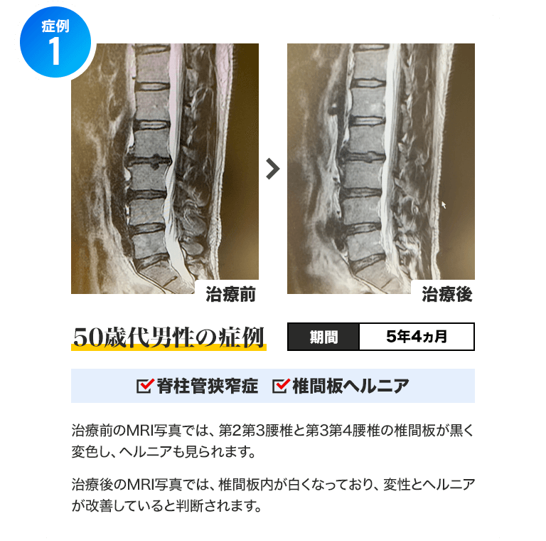症例1)50歳代男性 期間:5年4ヵ月 脊柱管狭窄症・椎間板変性症 :治療前のMRI写真では、第2第3腰椎と第3第4腰椎の椎間板が黒く変色し、ヘルニアも見られます。治療後のMRI写真では、椎間板内が白くなっており、変性とヘルニアが改善していると判断されます。