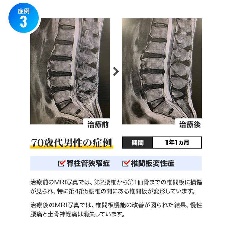 症例3)70歳代男性 期間:1年1ヵ月 脊柱管狭窄症・椎間板変性症 :治療前のMRI写真では、第2腰椎から第1仙骨までの椎間板に損傷が見られ、特に第4第5腰椎の間にある椎間板が変形しています。治療後のMRI写真では、椎間板機能の改善が図られた結果、慢性腰痛と坐骨神経痛は消失しています。