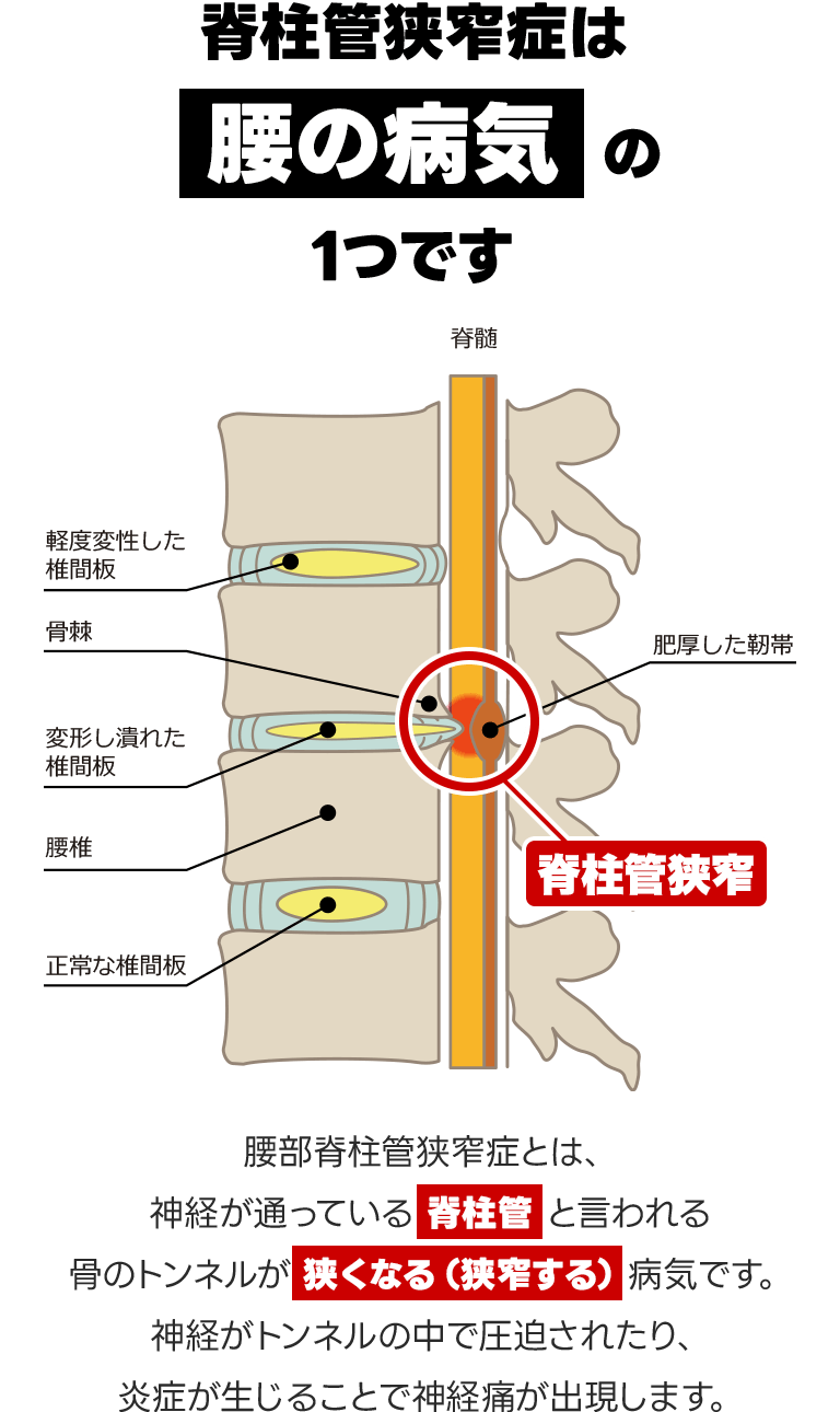 脊柱管狭窄症は腰の病気の1つです