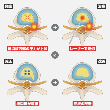 PLDD法（経皮的レーザー椎間板減圧術）