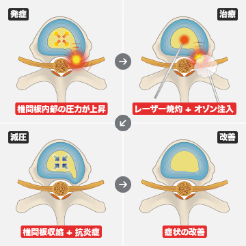 PLOT法（経皮的オゾンレーザー治療）