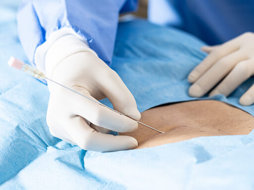 修復治療で使用する針