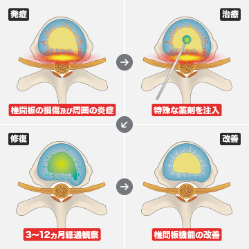 ディスクシール治療（Discseel®Procedure）