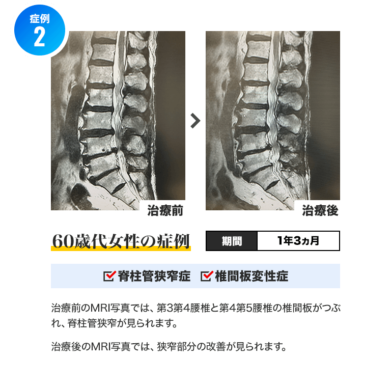 症例2)60歳代女性 期間:1年3ヵ月 脊柱管狭窄症・椎間板ヘルニア :治療前のMRI写真では、第3第4腰椎と第4第5腰椎の椎間板がつぶれ、脊柱管狭窄が見られます。治療後のMRI写真では、狭窄部分の改善が見られます。