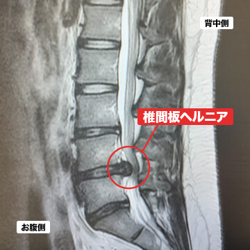 腰椎椎間板ヘルニア