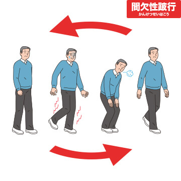 間欠性跛行