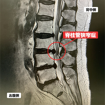 腰部脊柱管狭窄症