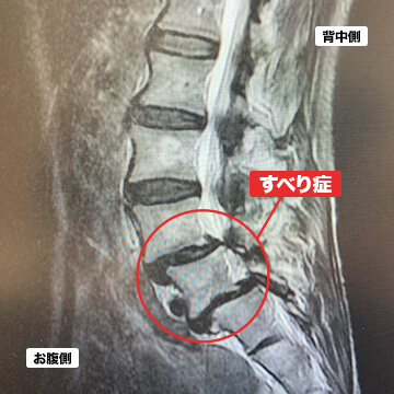 腰椎すべり症