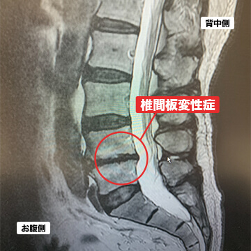 椎間板変性症