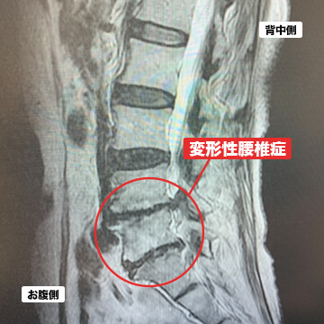 変形性腰椎症