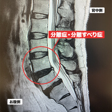 分離症・分離すべり症