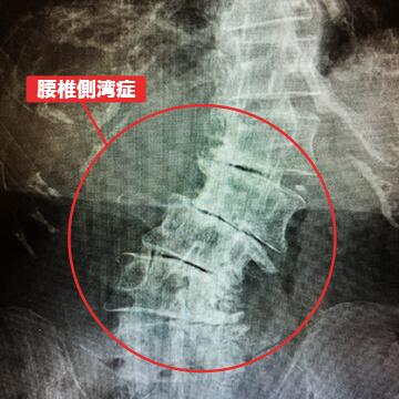 腰椎側湾症